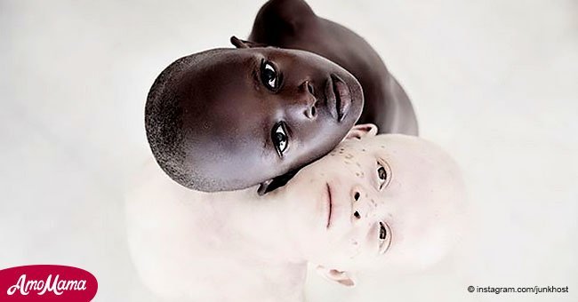 Niños albinos son cazados y asesinados en África por mafias que venden partes de sus cuerpos