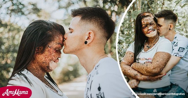Se enamoró de una mujer con una rara enfermedad en la piel y sus conmovedoras fotos lo prueban