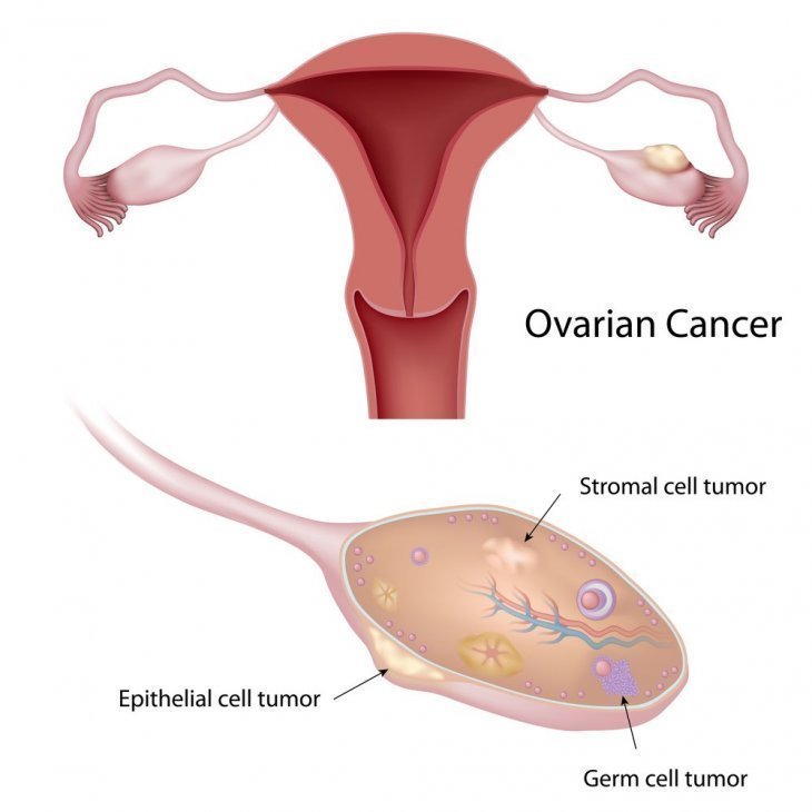 Cáncer de ovario. | Imagen tomada de: Shutterstock