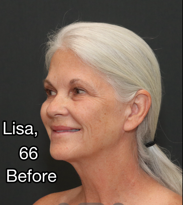 Lisa posa antes de la intervención, el 3 de abril de 2025 | Fuente: TikTok/@nayakplasticsurgery