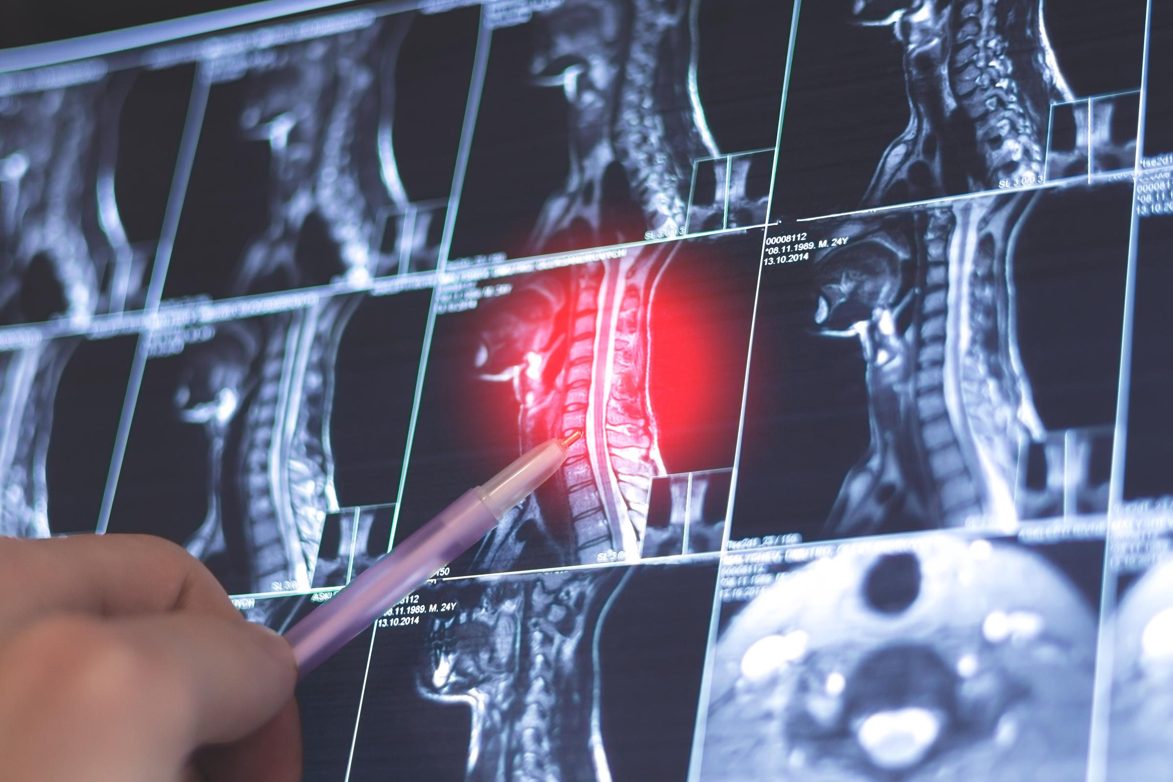 Resonancia magnética de la columna cervical que muestra una presunta espondilosis con compresión de la raíz nerviosa, revisada por un médico en busca de signos de radiculopatía y dolor cervical crónico | Fuente: Getty Images