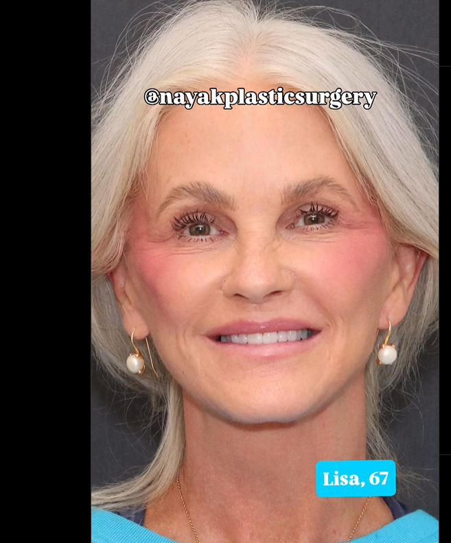 Lisa sonríe para la cámara, postoperada, vista en un post fechado el 1 de junio de 2025 | Fuente: Instagram/nayakplasticsurgery