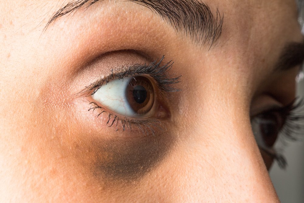 Círculos oscuros debajo de los ojos. | Foto: Shutterstock