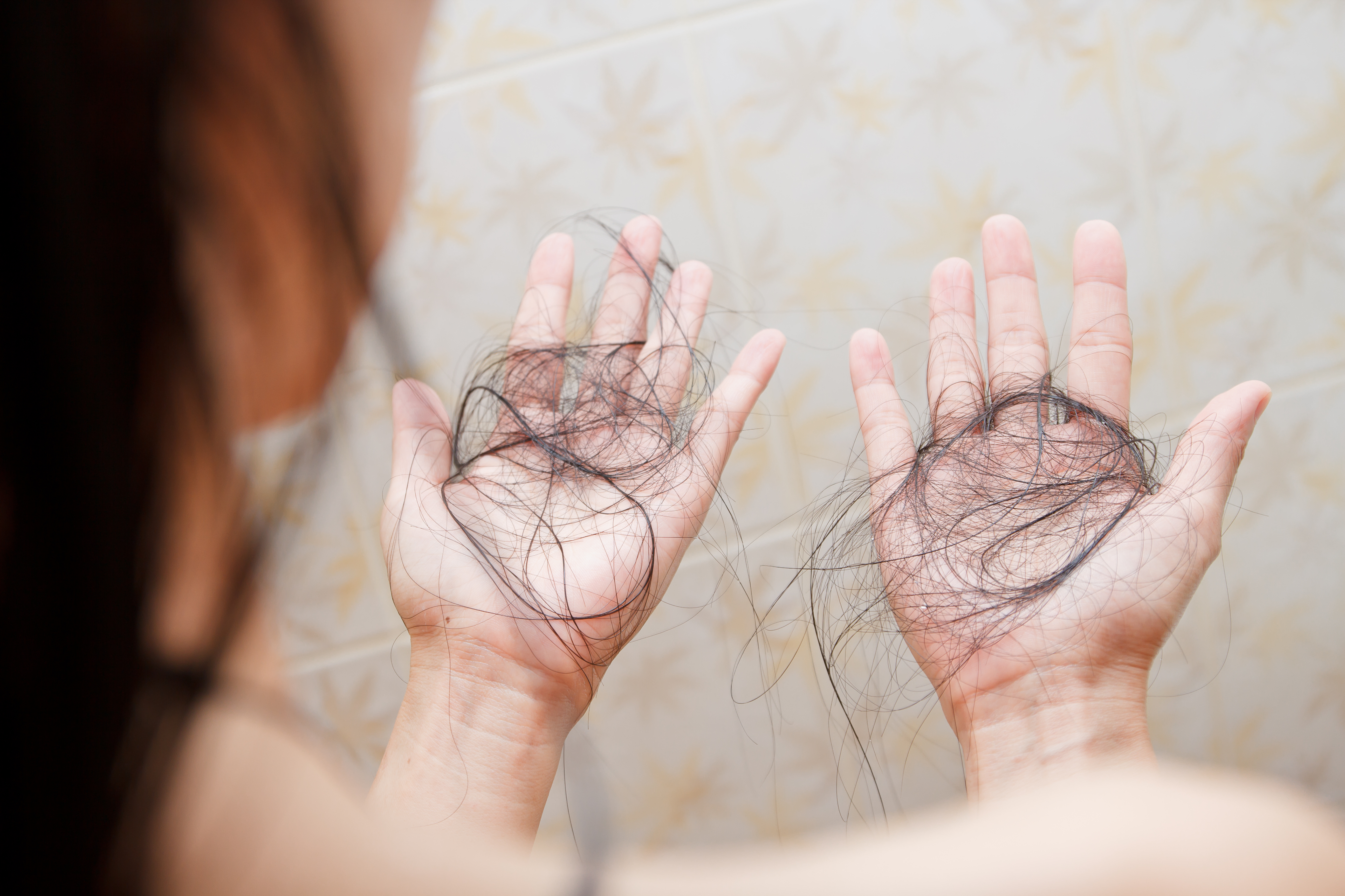 Una persona con pérdida de cabello. | Foto: Shutterstock