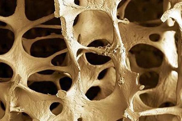 Imagen de hueso con osteoporosis. | Imagen: Flickr