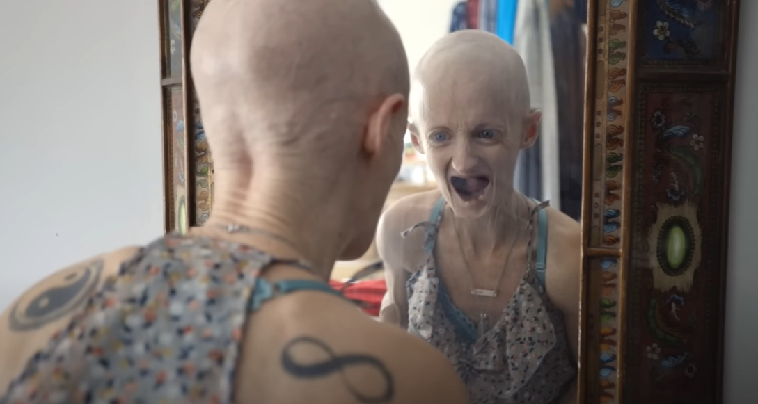 Tiffany Wedekind perdió los dientes a causa de la progeria | Foto: YouTube.com/Truly