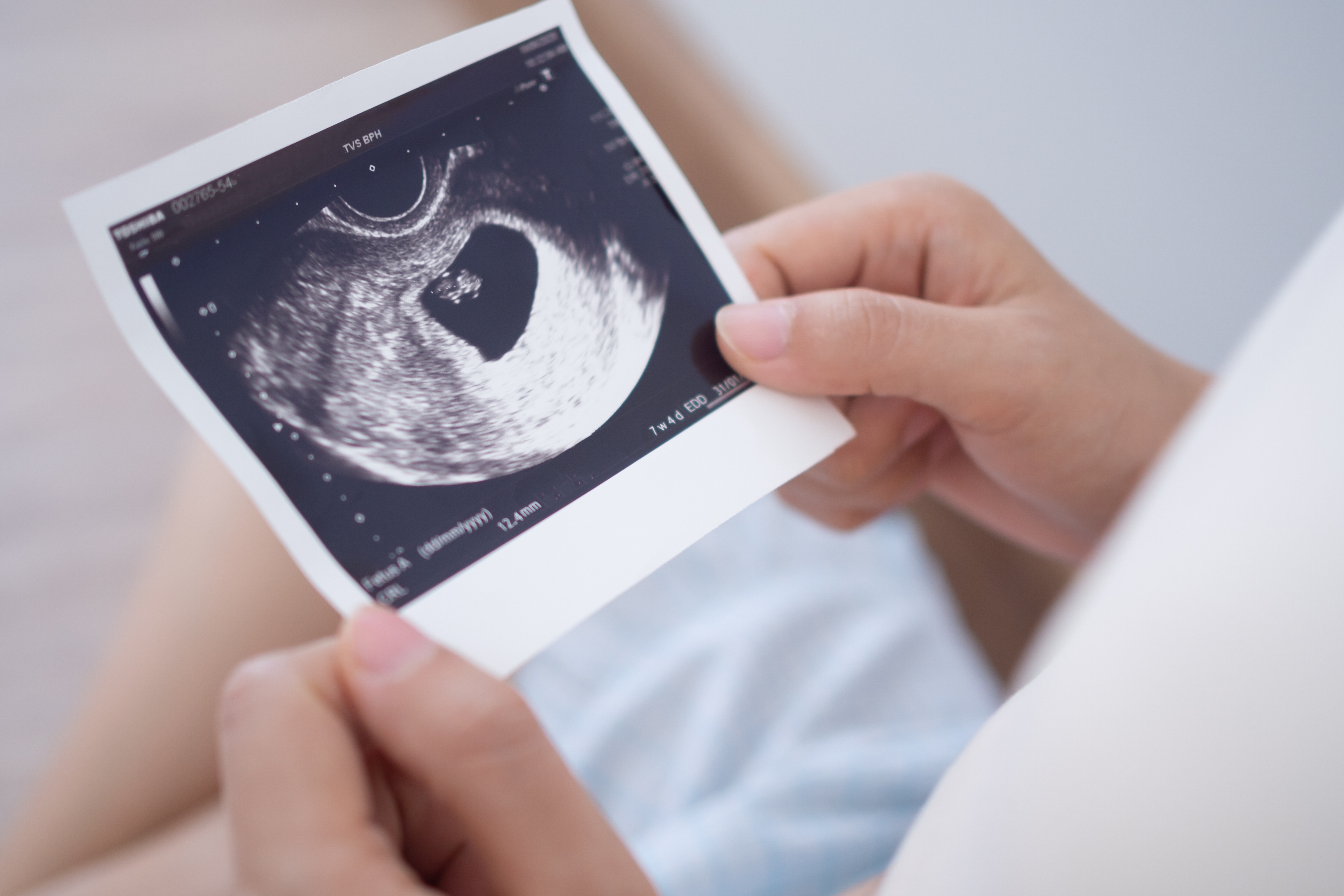 Una mujer sostiene la foto de la ecografía de un feto | Fuente: Shutterstock