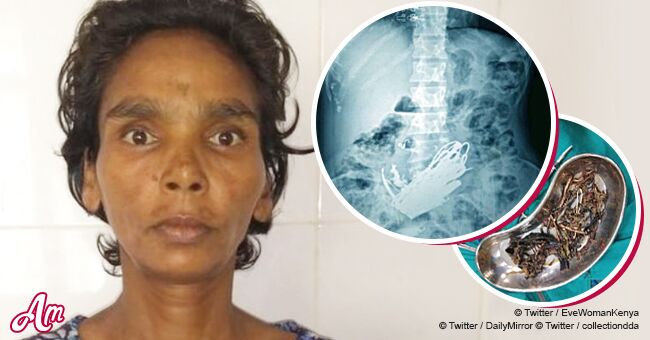 Impresionantes rayos X de mujer revelan kilo y medio de tuercas, tornillos y joyas en el estómago