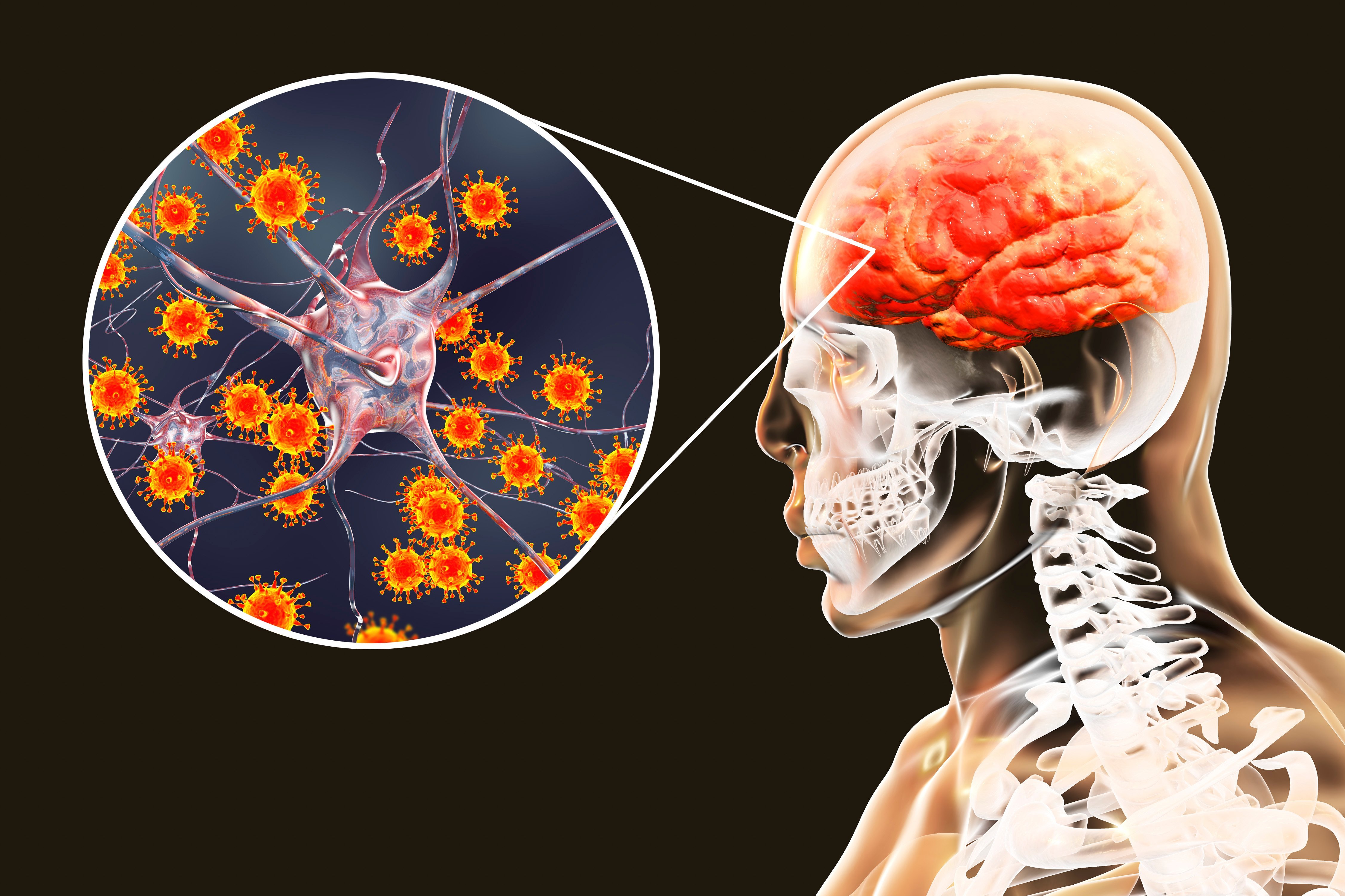 Ilustración de ecnefalitis en el cerebro. Fuente: Shutterstock