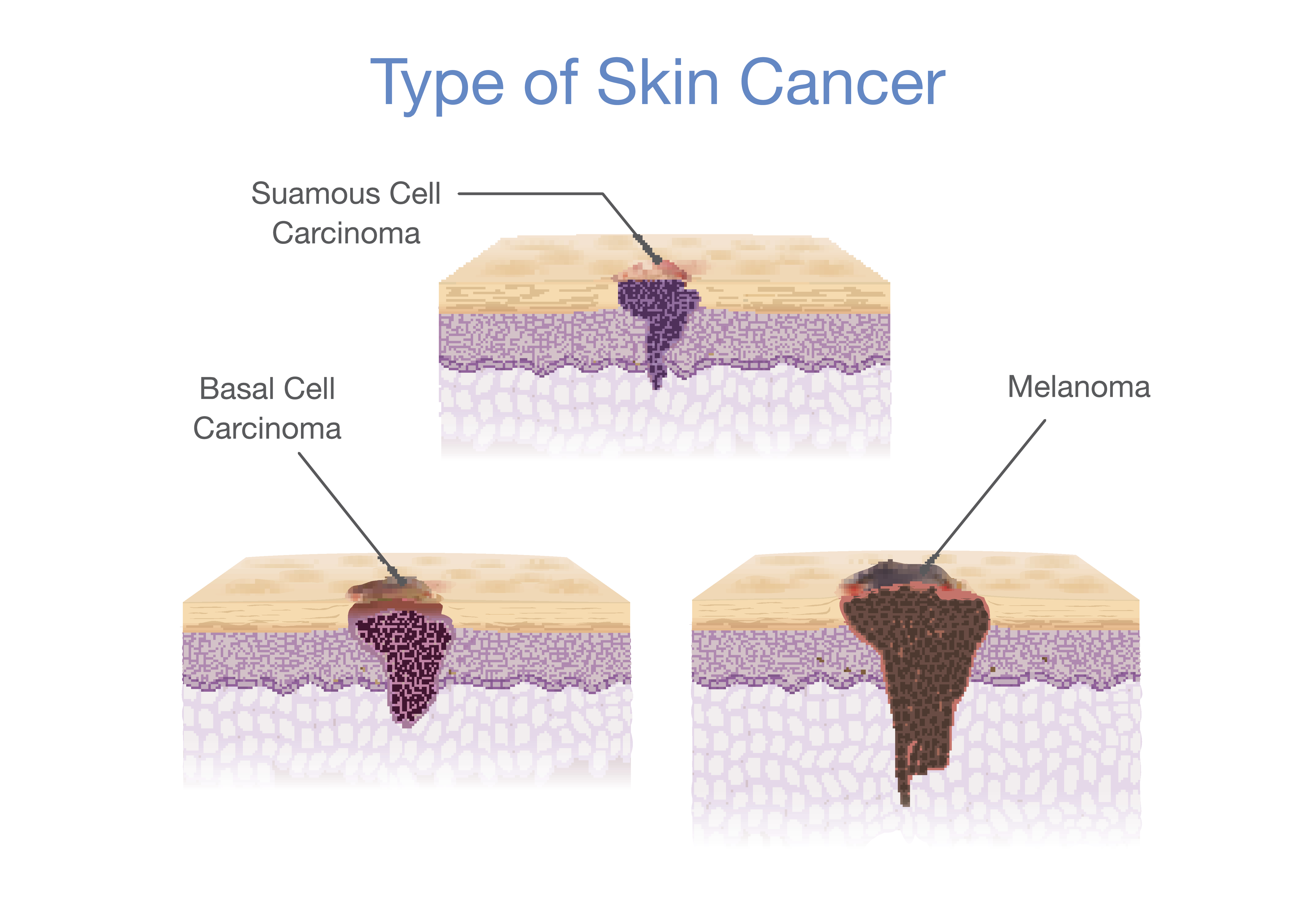 Tipos de cáncer de piel ilustrados en estilo vectorial 3D. Representación médica | Fuente: Getty Images