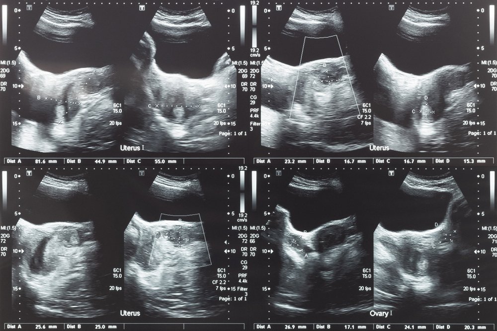 Imagen de ultrasonido de abdomen inferior, ovario y útero con fibroma uterino. Fuente: Shutterstock