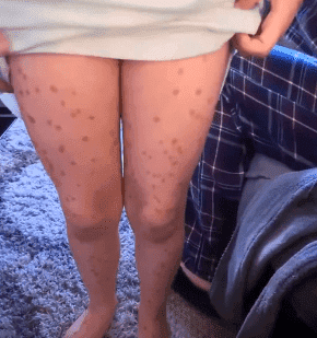 Lily mostrando las marcas en sus piernas.| Imagen tomada de: YouTube/ Jane Choem