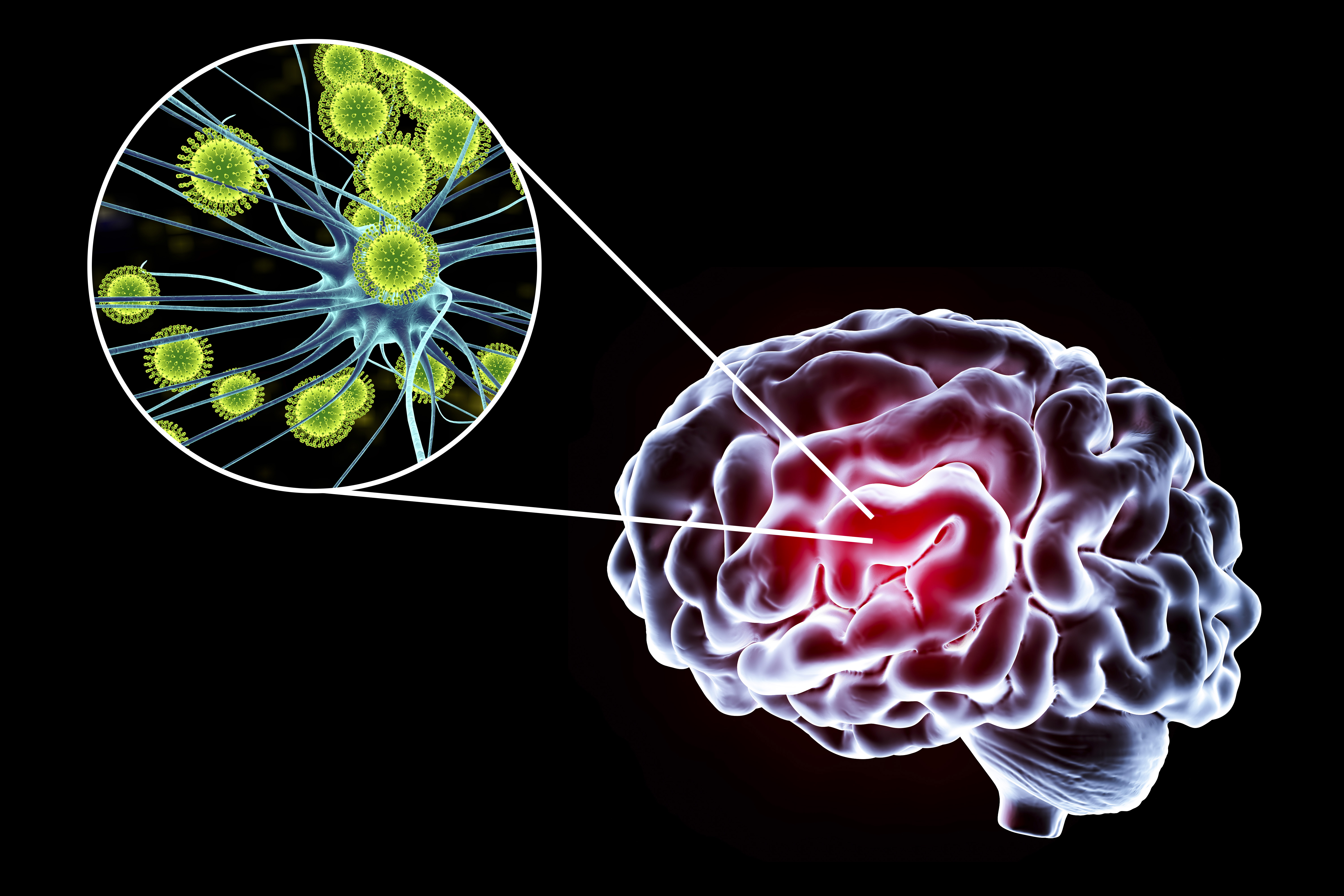 Ilustración conceptual que muestra el cerebro y un primer plano de los virus que infectan las neuronas | Fuente: Getty images