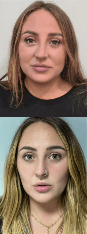 El antes (foto superior) y después (foto inferior) del procedimiento.│ Foto: Captura de Instagram/ clinicabruselas