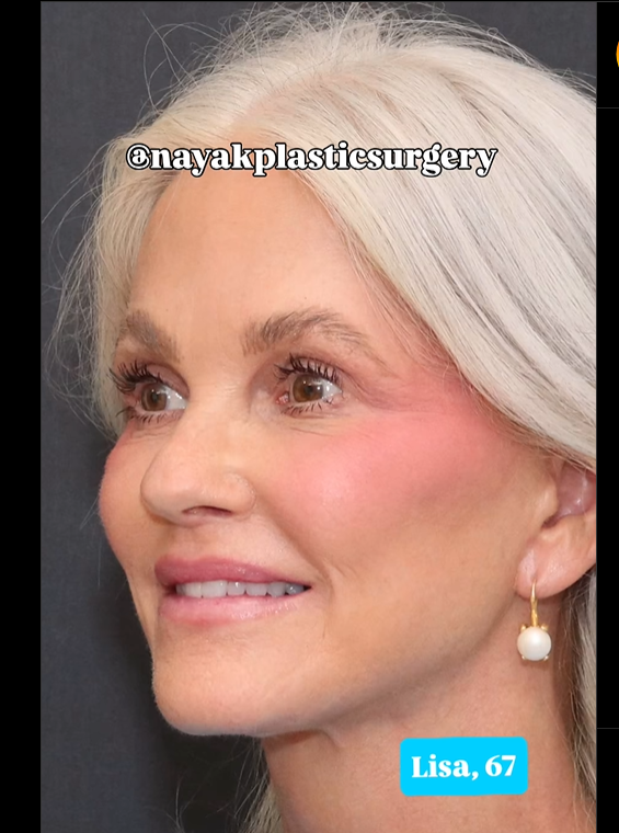 Lisa después de la operación, en un post del 1 de junio de 2025 | Fuente: Instagram/nayakplasticsurgery