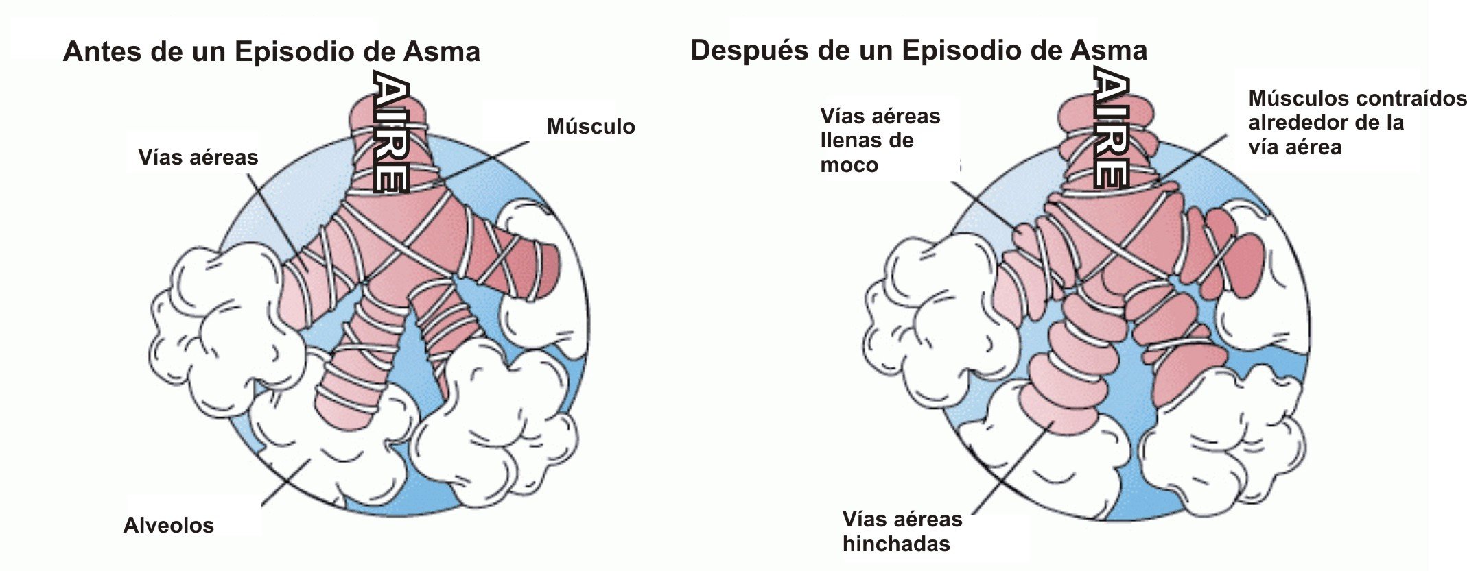 Esquema sobre el asma. | Imagen: Wikipedia
