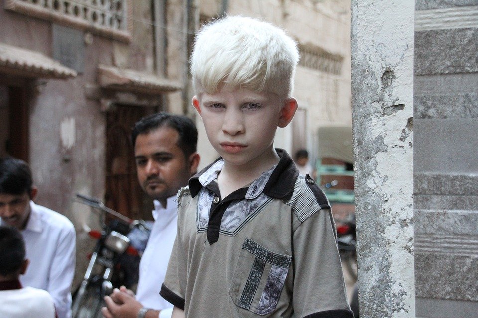 Niño con albinismo │Imagen tomada de: Pixabay