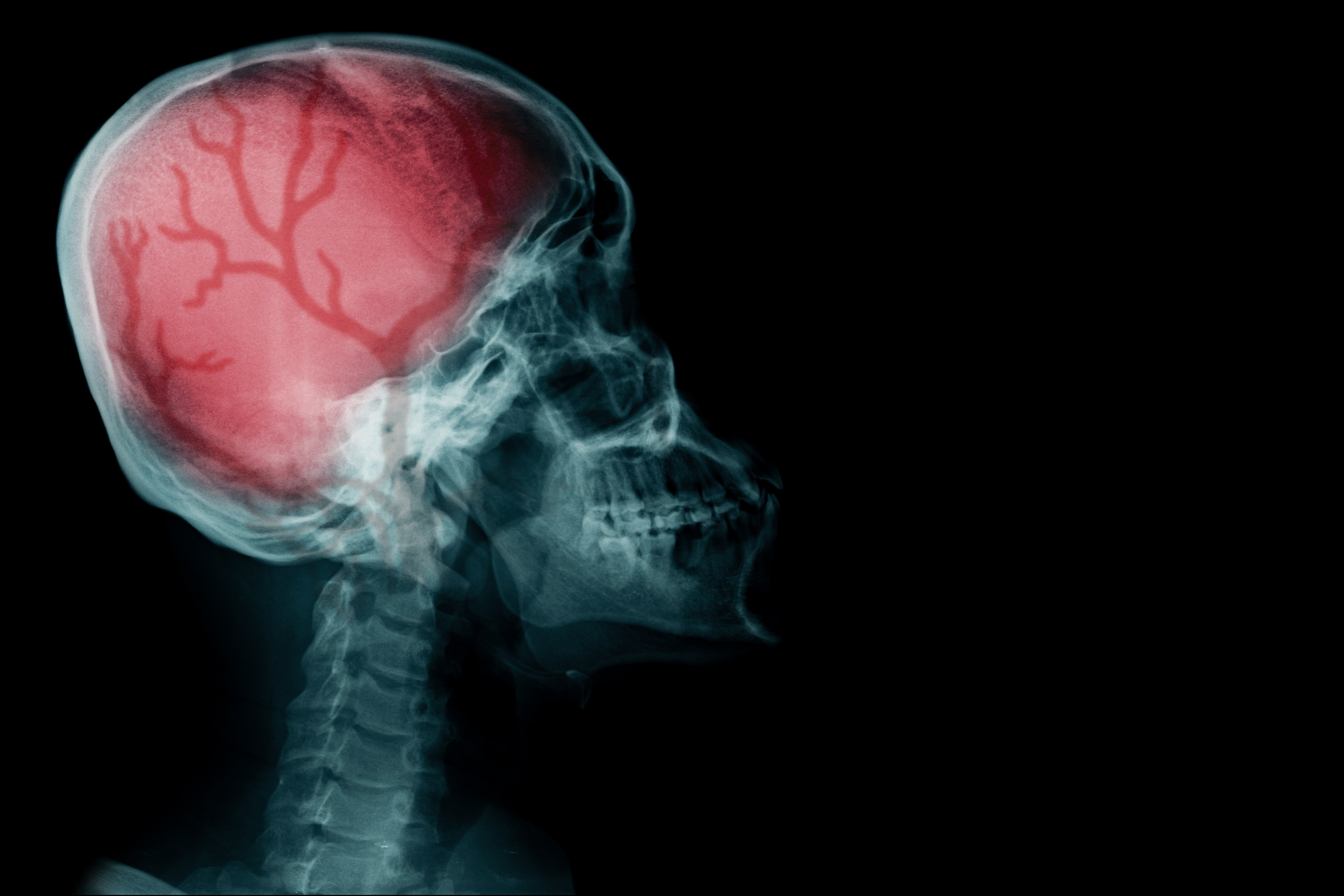 Radiografía de una cabeza. Fuente: Shutterstock