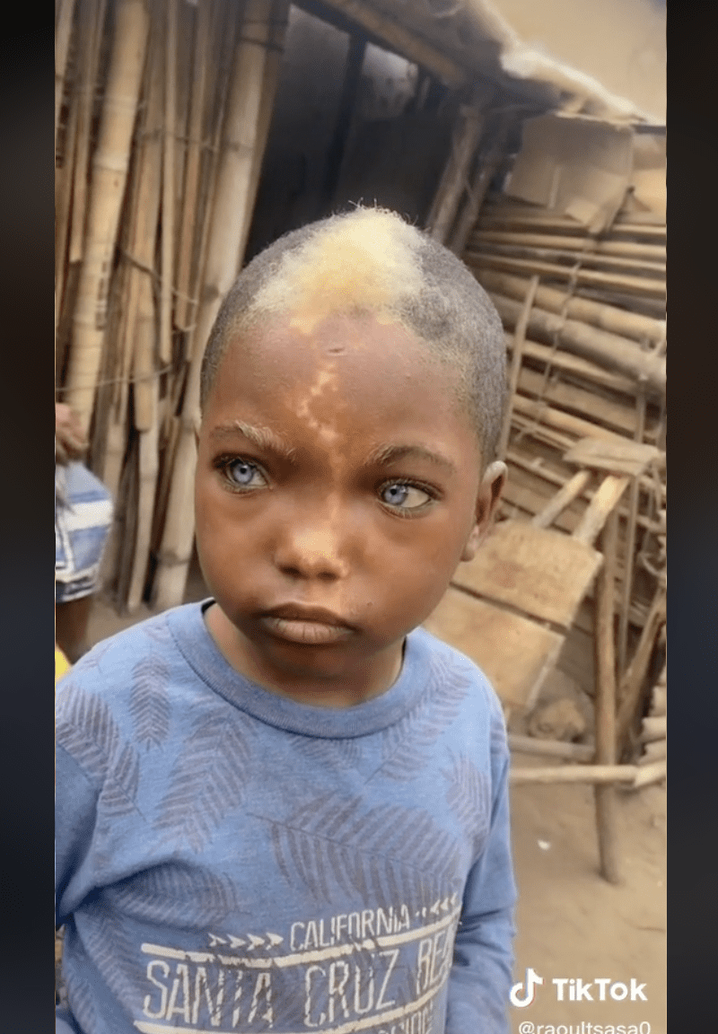 Niño negro de ojos azules con una marca en su frente y cabello blanco | Foto: tiktok.com/@raoultsasa0