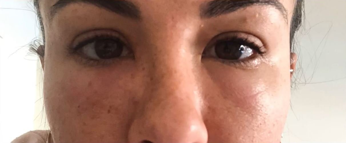 Susana Megan muestra a través de su videoblog, la manera en que se inflamó su cara tras su tratamiento estético. | Foto: Mtmad/ Con locura Susana Megan.